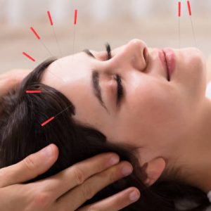 Relaxed Young Woman Receiving Acupuncture Treatment In Beauty Spa